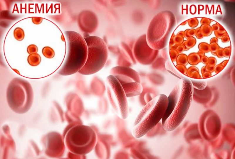 ВОЗ впервые разработала программу по борьбе с анемией