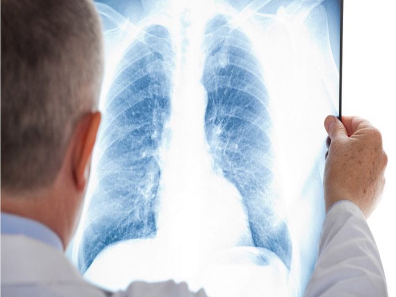 Информация о заболеваемости пневмонией с признаками коронавирусной инфекции на 18 апреля 2023 года