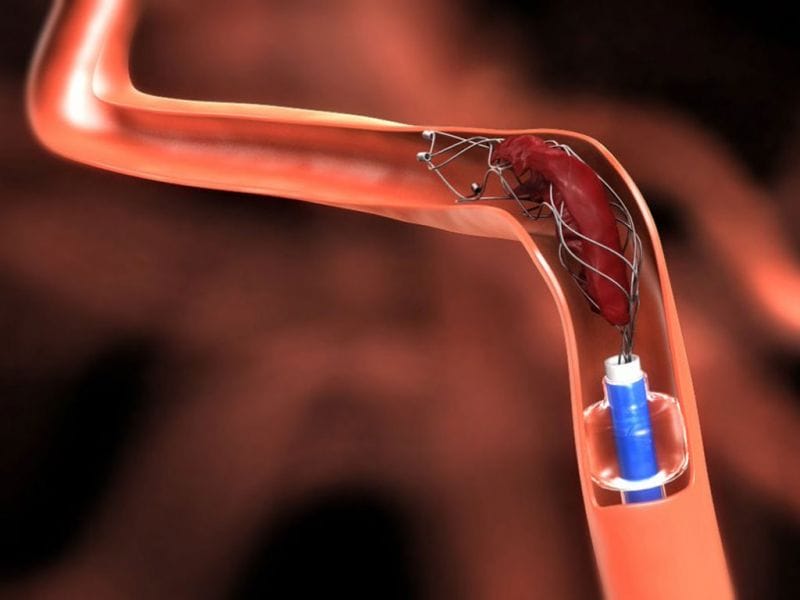 В Жетісу внедрили уникальный метод удаления тромбов из сосудов при инсульте